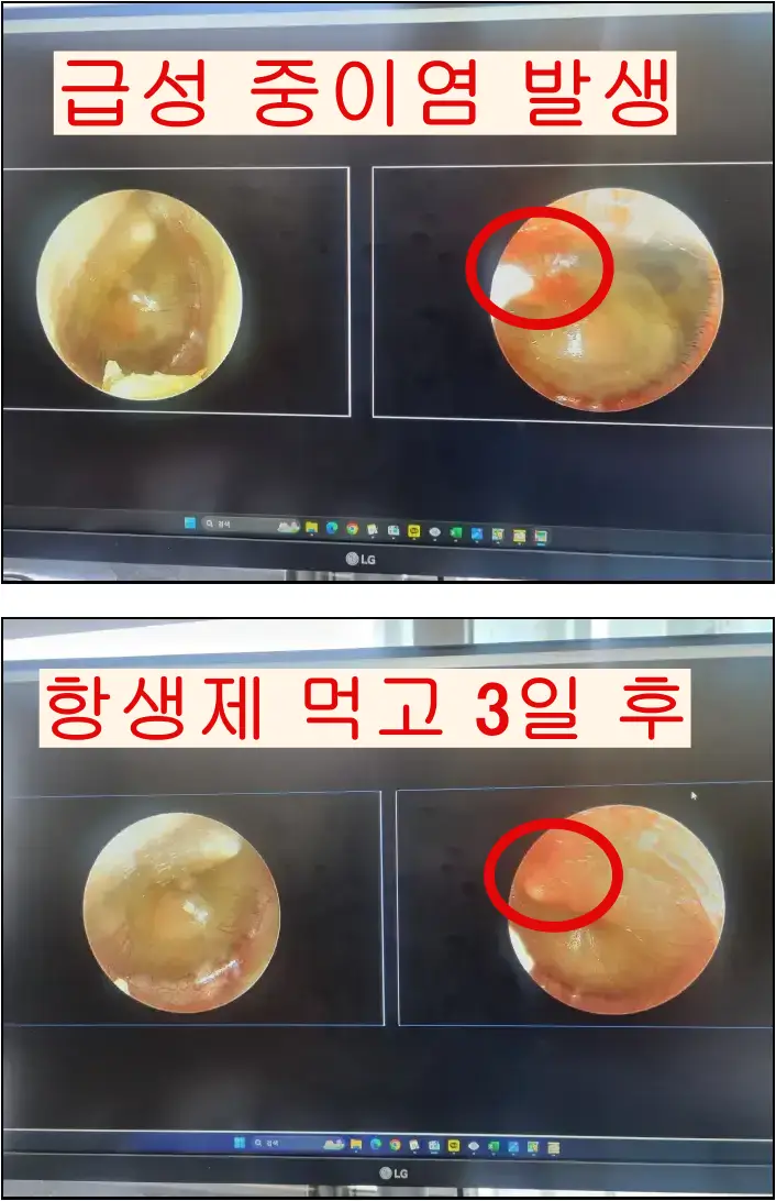 급성 중이염이 발생 후 항생제 먹고 3일 후 증상 사진